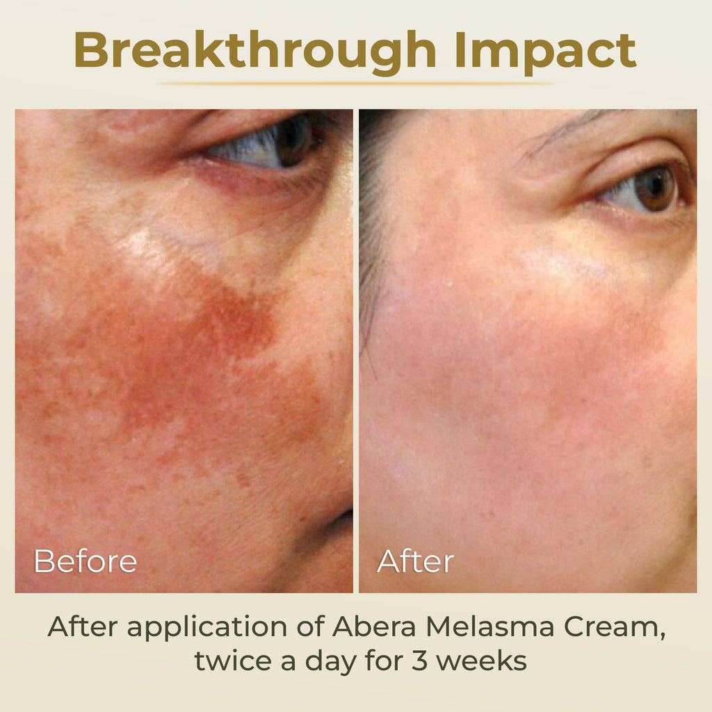 ABERA Melasma Cream - Dark Spot Corrector for Freckles & Sun Spots