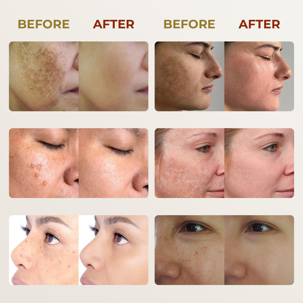 ABERA Melasma Cream - Dark Spot Corrector for Freckles & Sun Spots