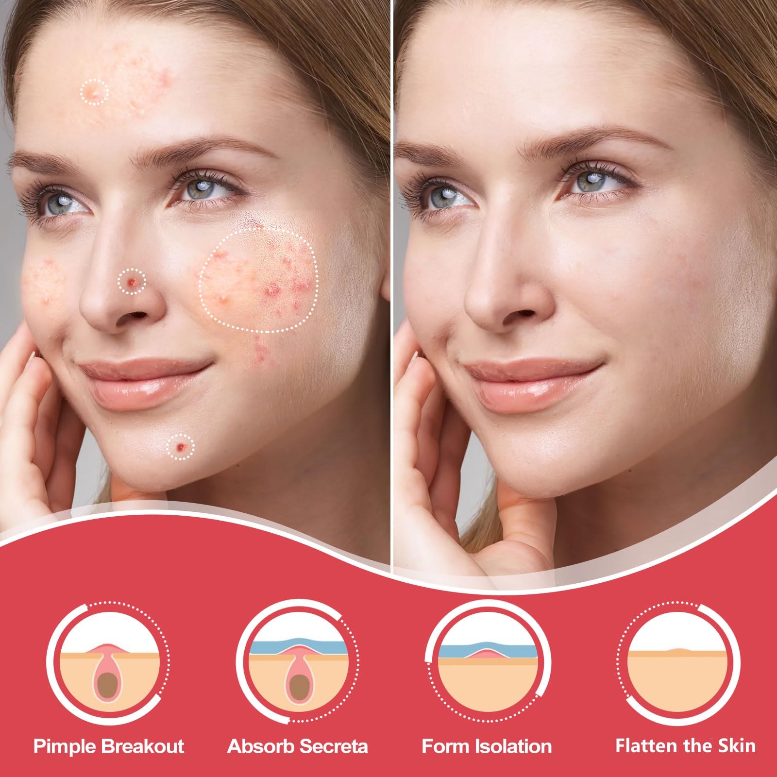 AcneGo 432 Counts Pimple Patches – Invisible Hydrocolloid Patches for All Skin Types