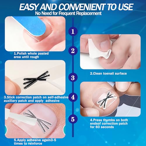 Aethyron Ingrown Toenail Corrector | Upgraded 6-Angle Titanium Alloy Kit (9 Pcs)