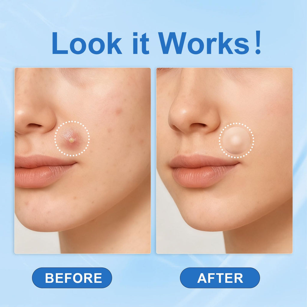 Amouy Acne Pimple Patch – 2 Sizes, 612 Dots Hydrocolloid Patches with Witch Hazel, Tea Tree & Calendula