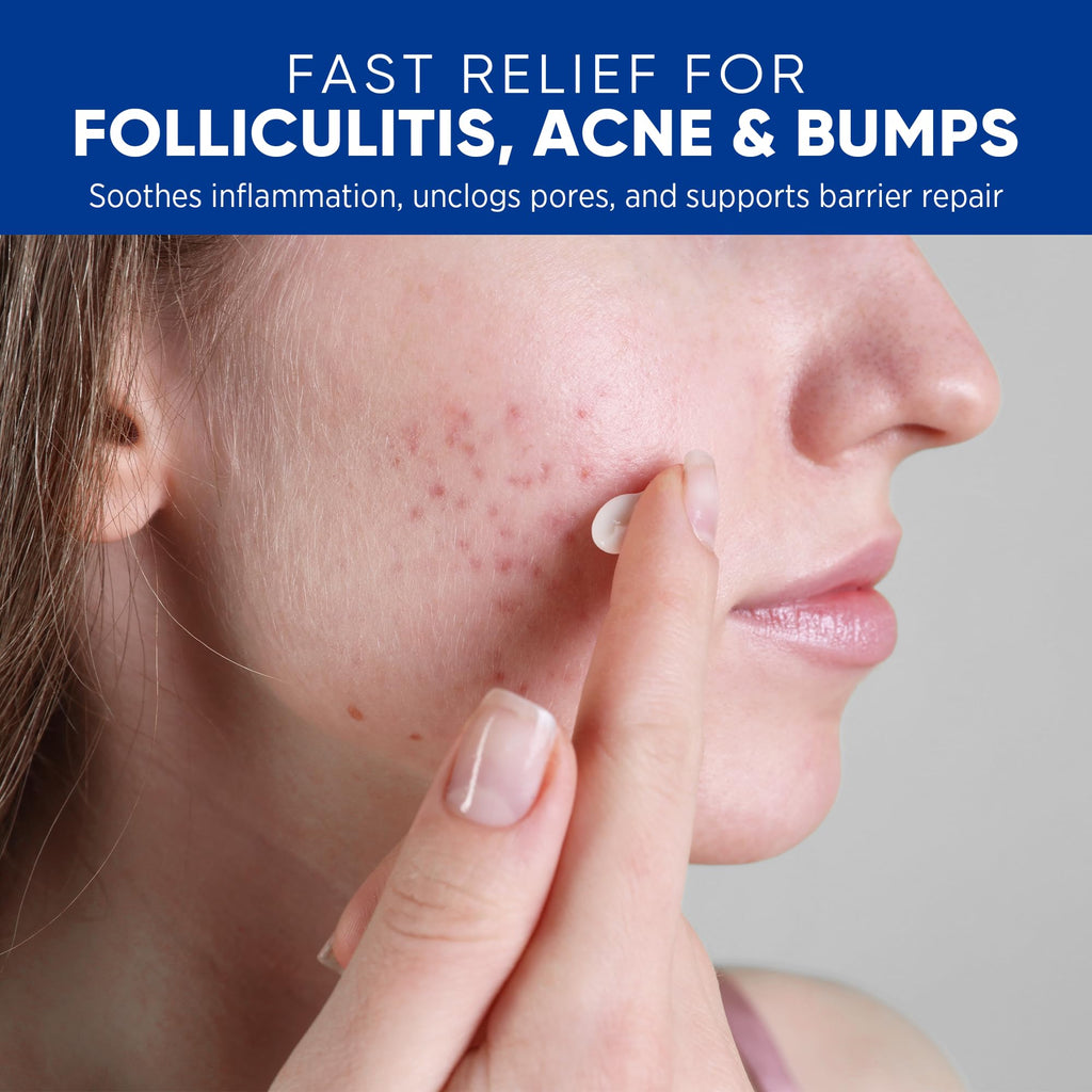 AOSORW Folliculitis & Acne Treatment Cream – 1% Salicylic Acid & Herbal Extracts, 100g