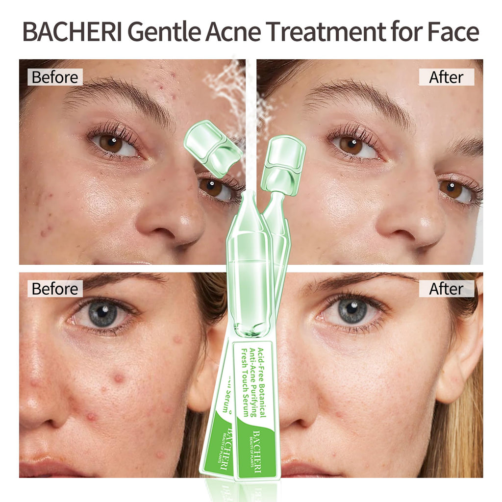 BACHERI Gentle Botanical Acne Serum – Niacinamide & Witch Hazel, 1.2 ml × 30 Ampoules