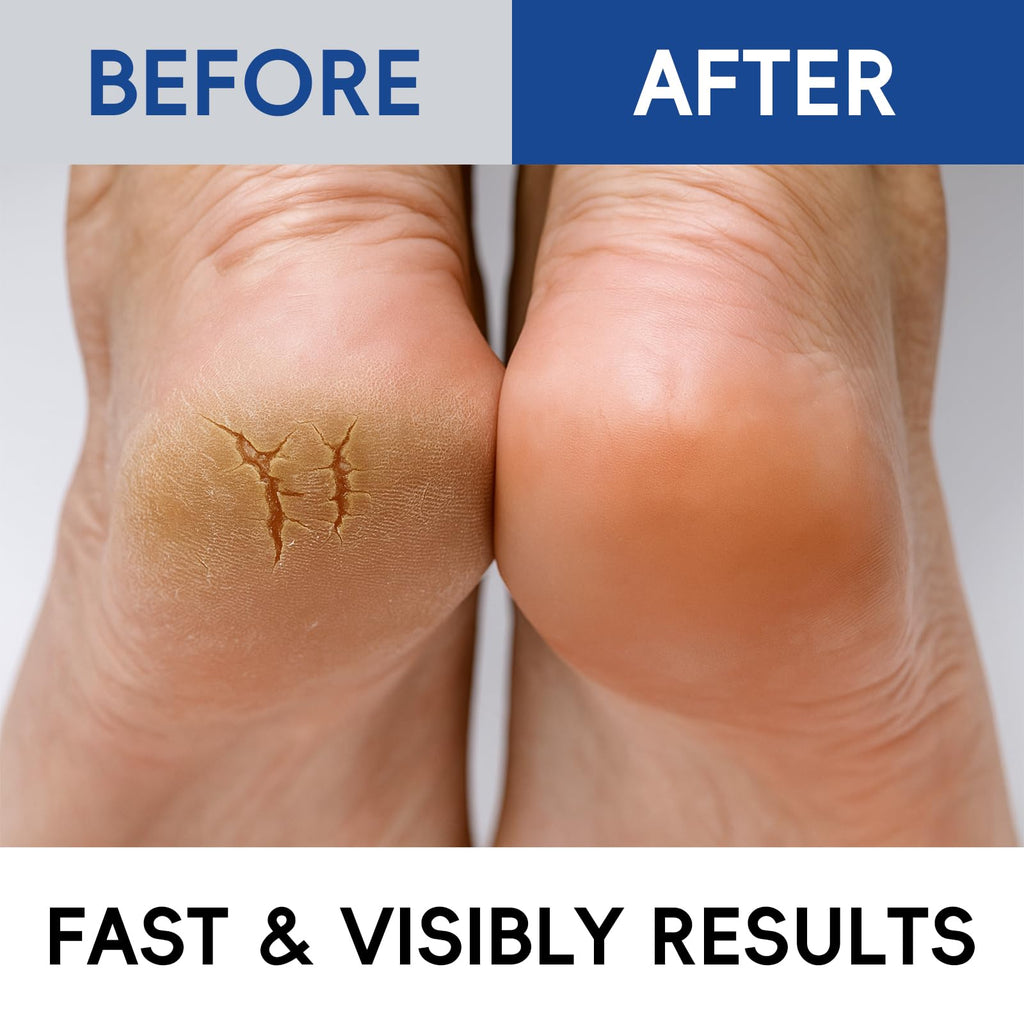 BeauBase 2 Pack Urea Cream 40% + 2% Salicylic Acid – Deep Hydration for Feet & Hands (3.53 oz)