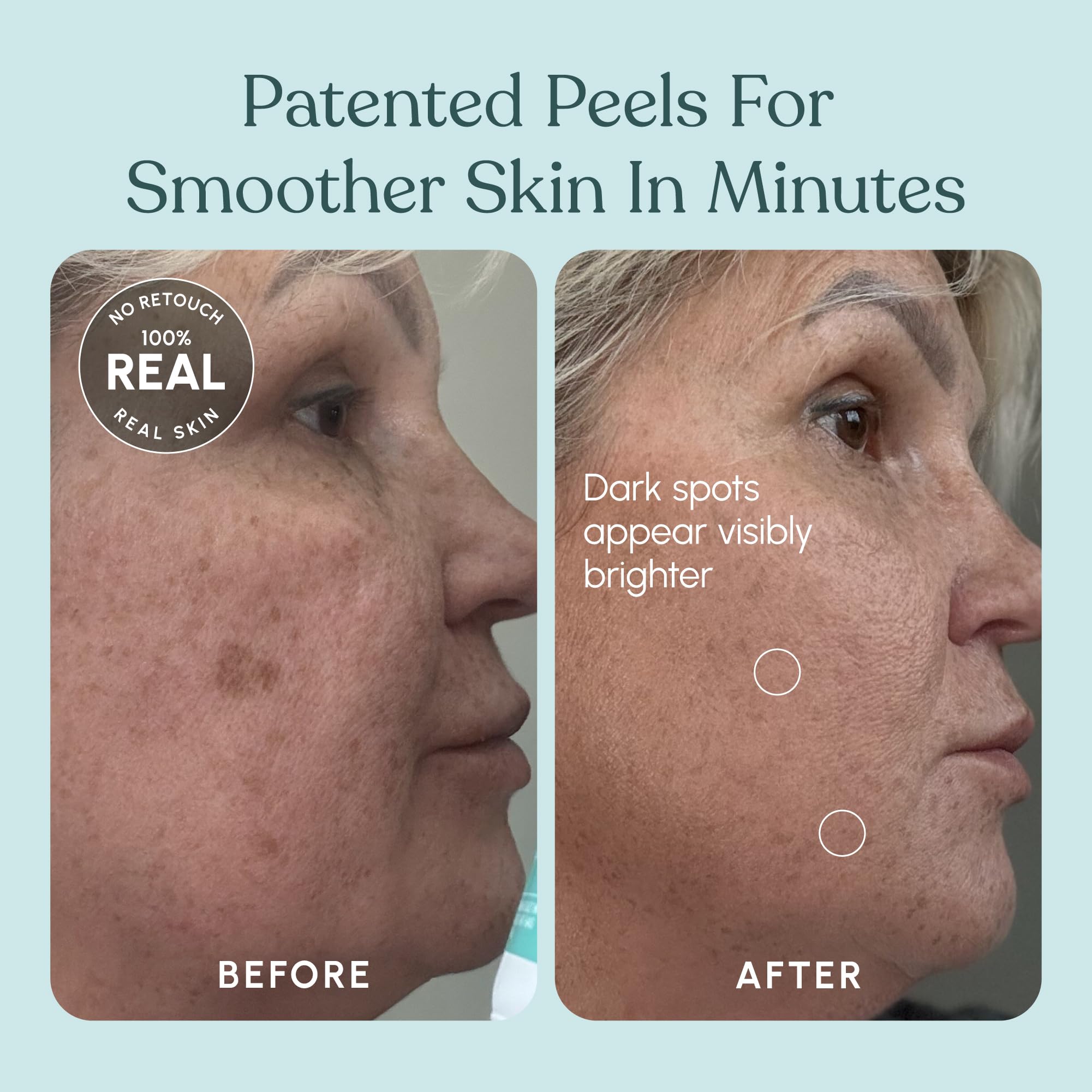 Beautiste 30 Day Miracle AHA 30% + BHA 2% Peel – Pore Refining Exfoliant