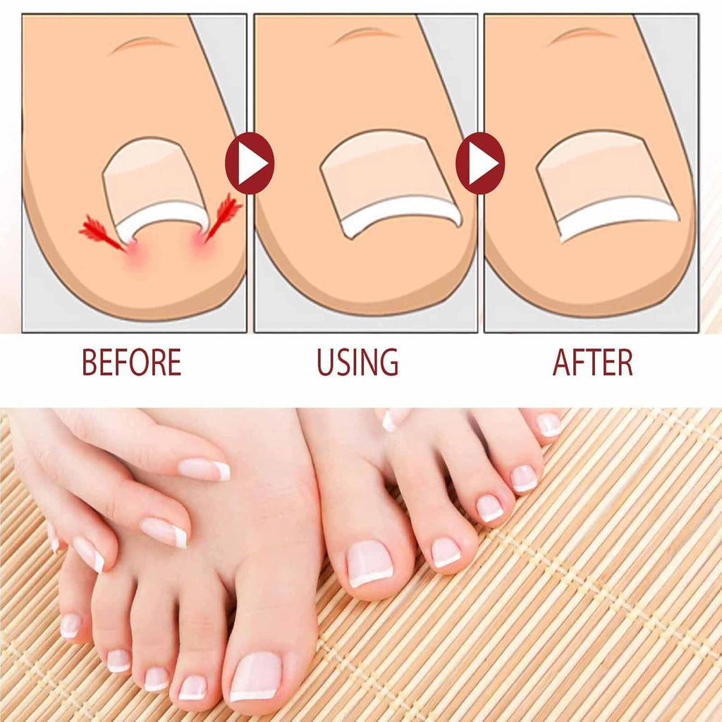 Beuifvo Nail Fungus Treatment Gel – Natural Nail Repair & Growth Serum (2pcs)