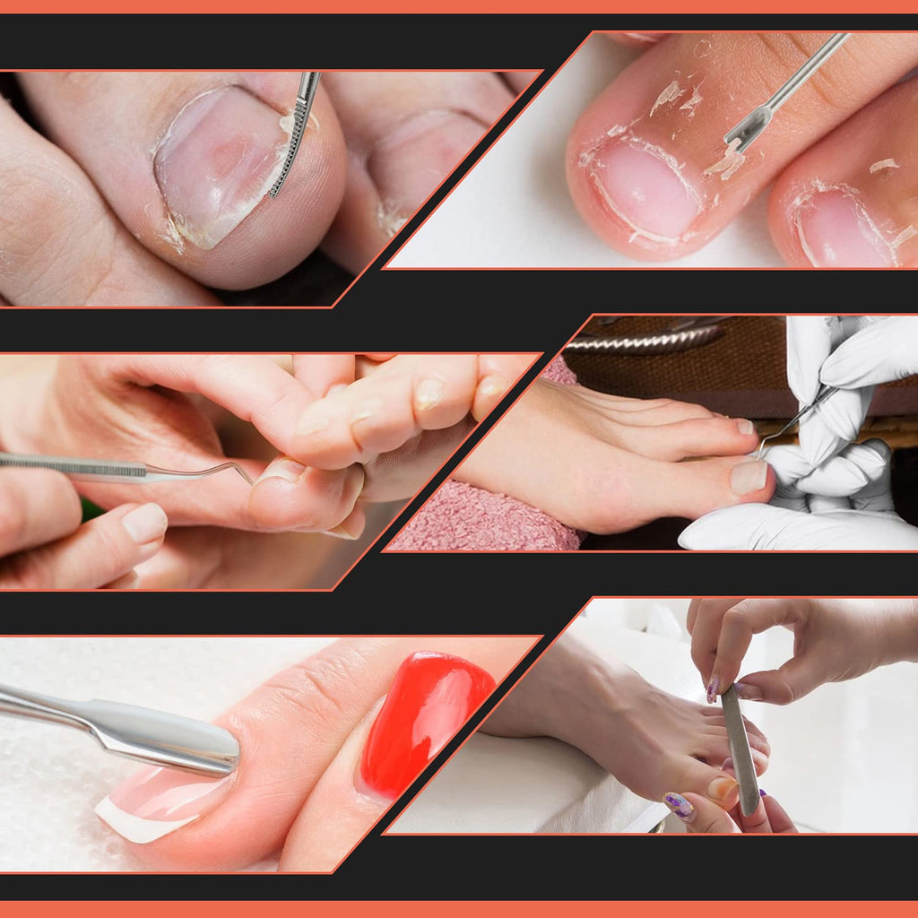 BEZOX Ingrown Toenail Removal Kit – Stainless Steel Pedicure Tools, 6-Piece Nail Correction Set