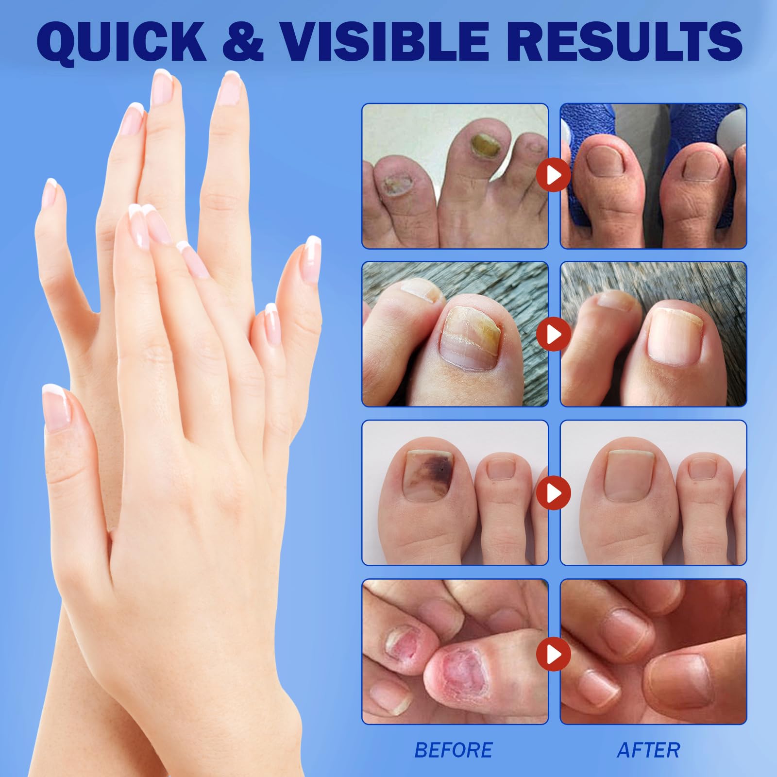 BFGCKJ Fungal Nail Patches for Toenails – 42 Count, 8-Hour Overnight Adhesion
