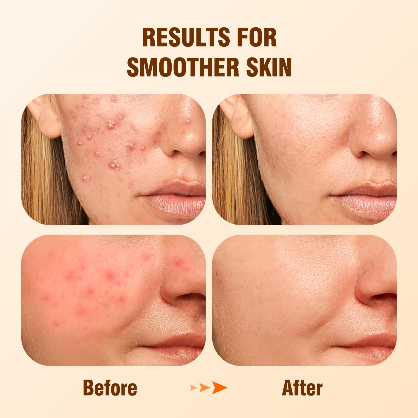 BIYSBER Salicylic Acid 2% Serum – Acne-Prone Skin, Oil Control & Hydration
