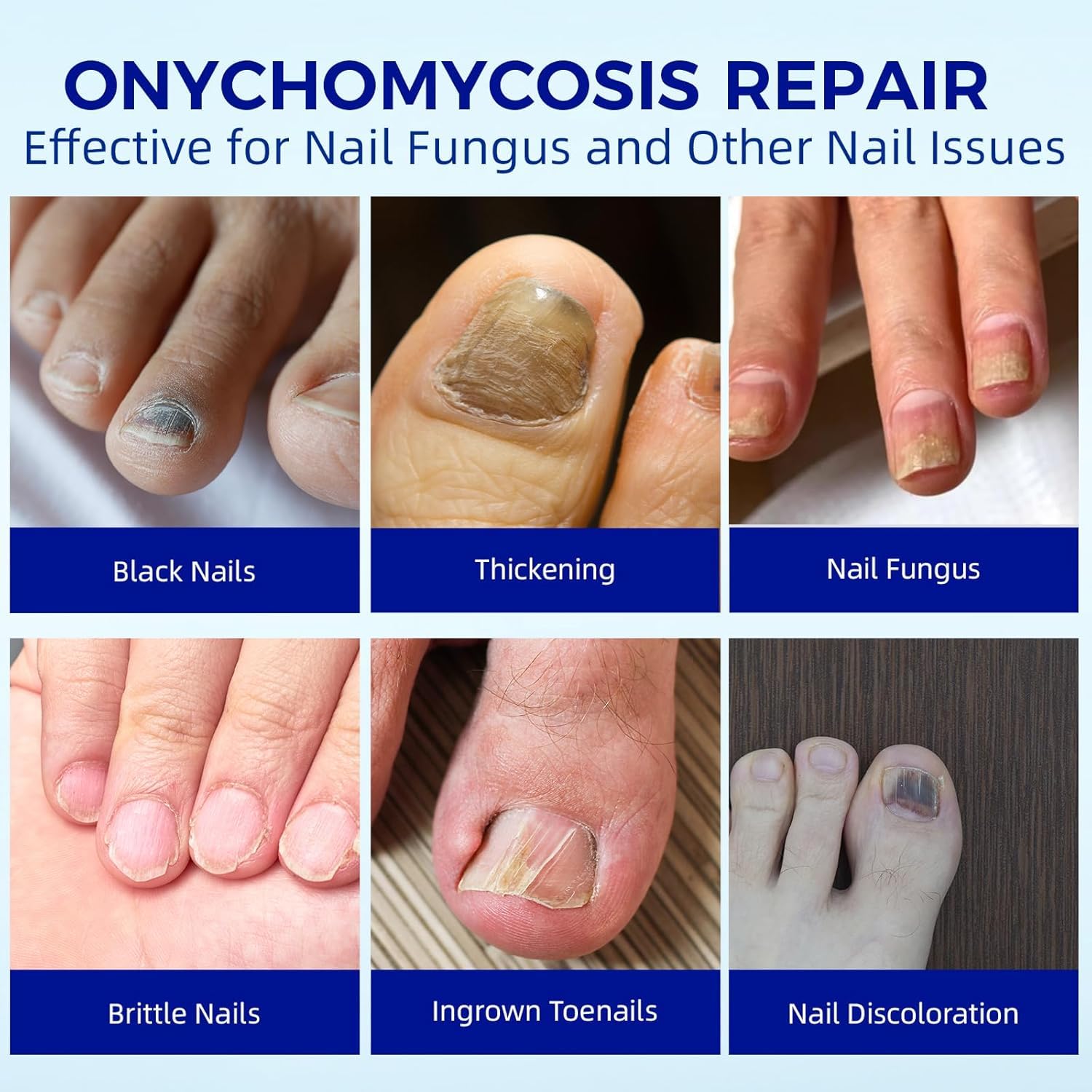 BOELIKAYS Fungal Nail Patches - Extra Strength Toenail Treatment (2pcs, Odorless)