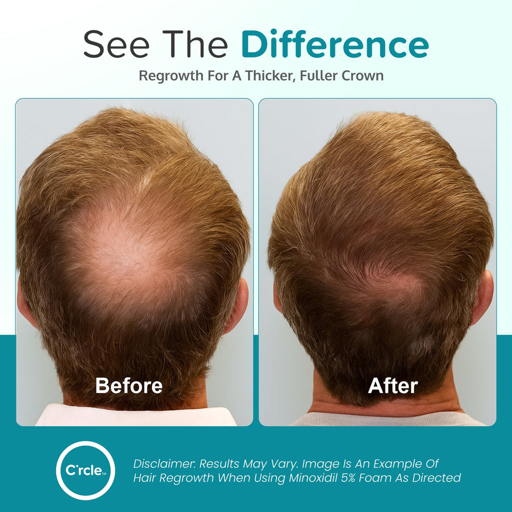 C'rcle Minoxidil 5% Foam for Men – Unscented, 3-Month Supply | Vertex Hair Loss & Thinning Support