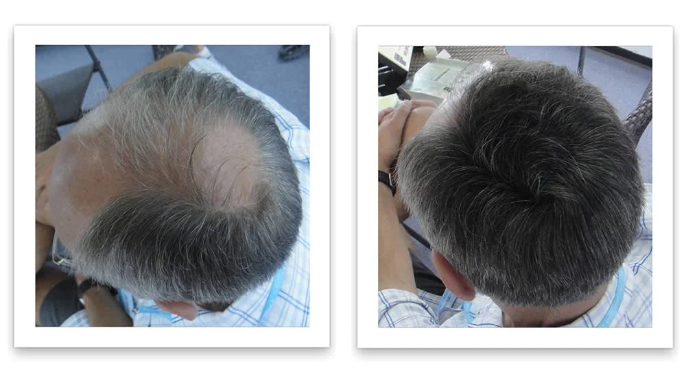 Caboki Hair Loss Concealer – 90-Day Dark Gray Coverage, Instant Fuller Look