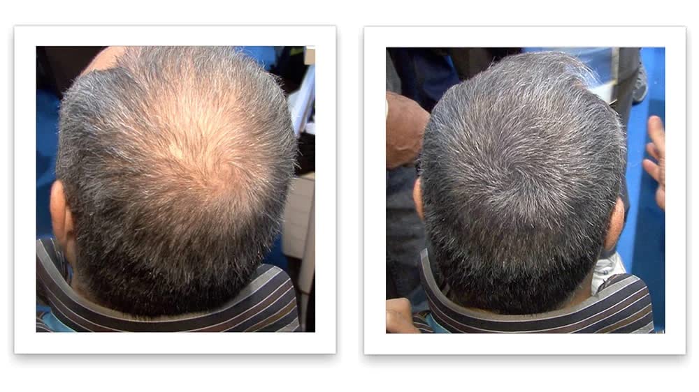 Caboki Hair Loss Concealer – 90-Day Dark Gray Coverage, Instant Fuller Look