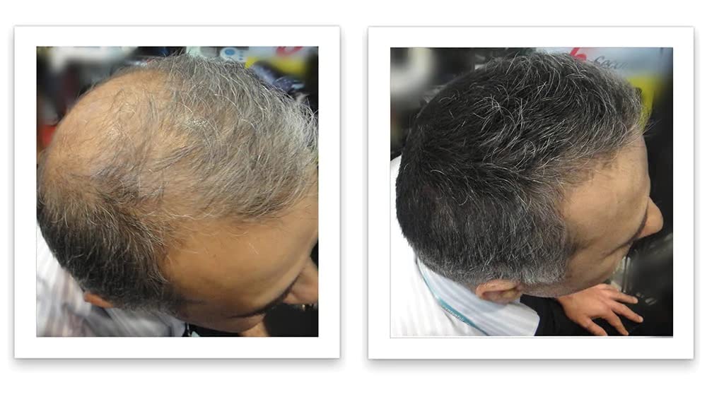 Caboki Hair Loss Concealer – 90-Day Dark Gray Coverage, Instant Fuller Look