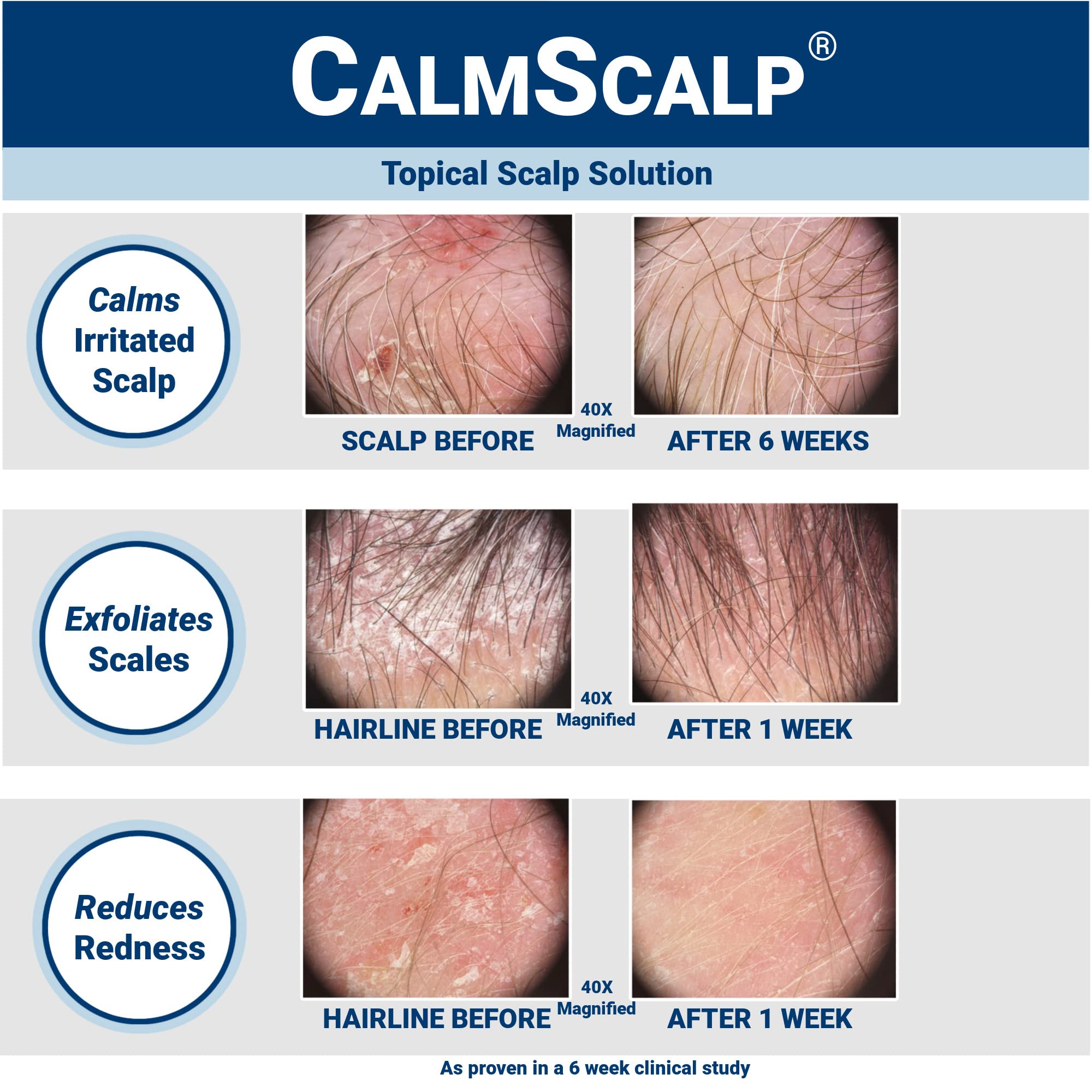 CalmScalp Scalp Treatment - Itch Relief, Flake Reduction, Made in USA - 4 oz