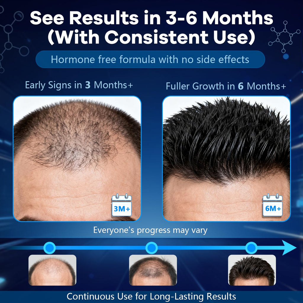 CARENICE 5% Minoxidil Foam for Men with Biotin – Unscented, 10.55 oz (Compare to Rogaine)