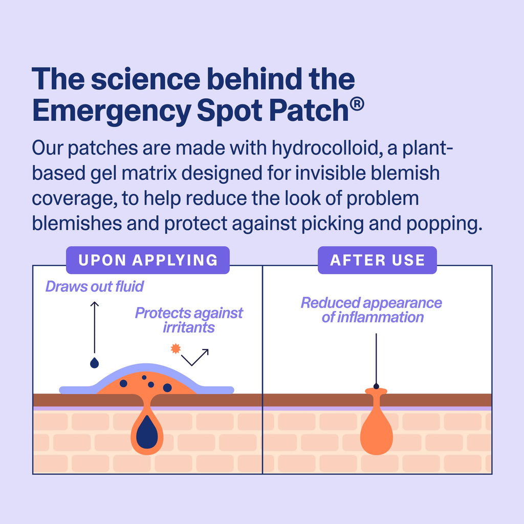 Curology Emergency Spot Patches for Face – Fast-Acting Hydrocolloid (80 Count)