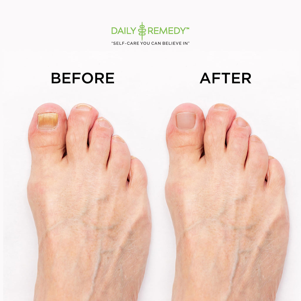 DAILY REMEDY EXTRA STRENGTH Tea Tree Oil Foot Soak with Epsom Salt – Made in USA, 16 oz