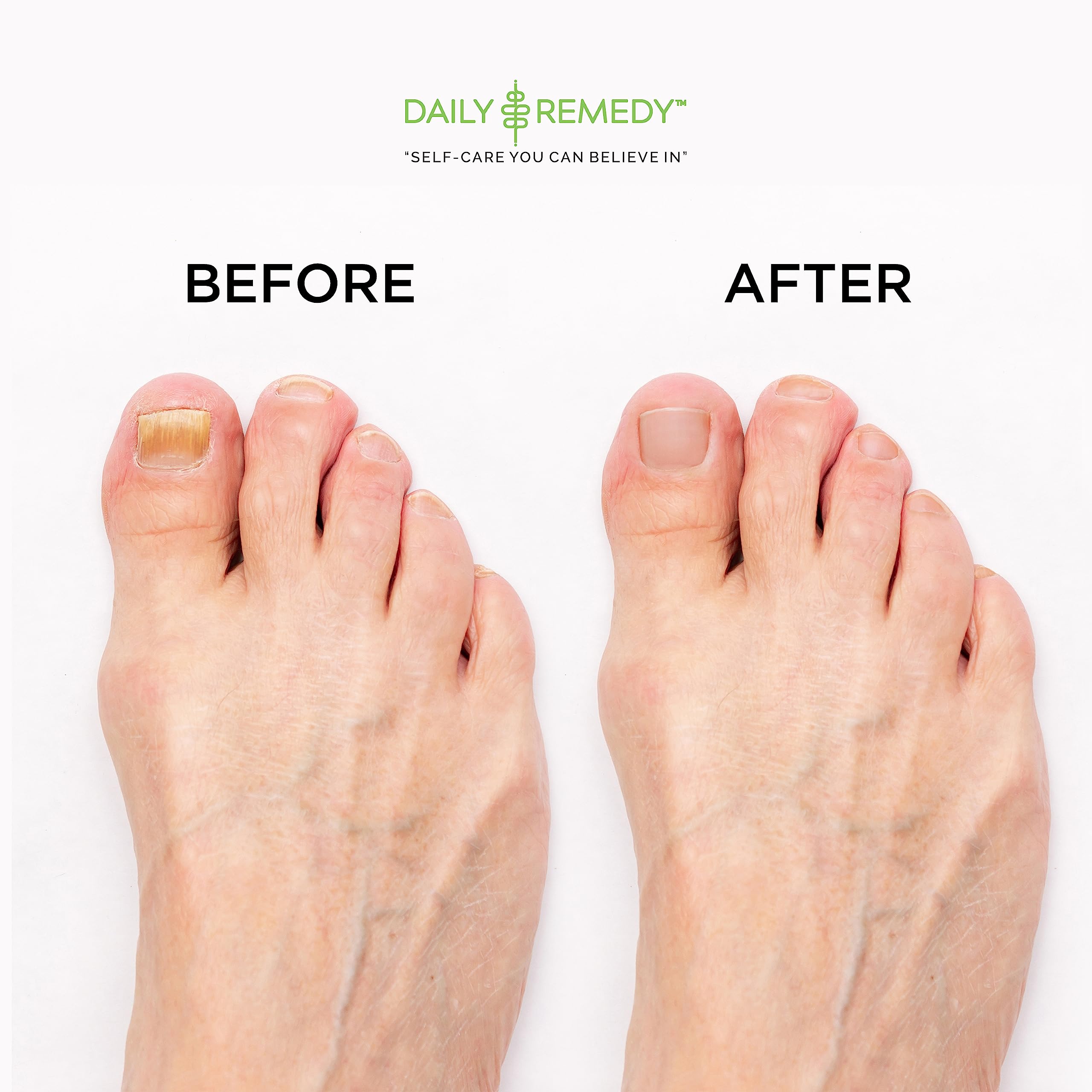DAILY REMEDY EXTRA STRENGTH Tea Tree Oil Foot Soak with Epsom Salt – Made in USA, 16 oz