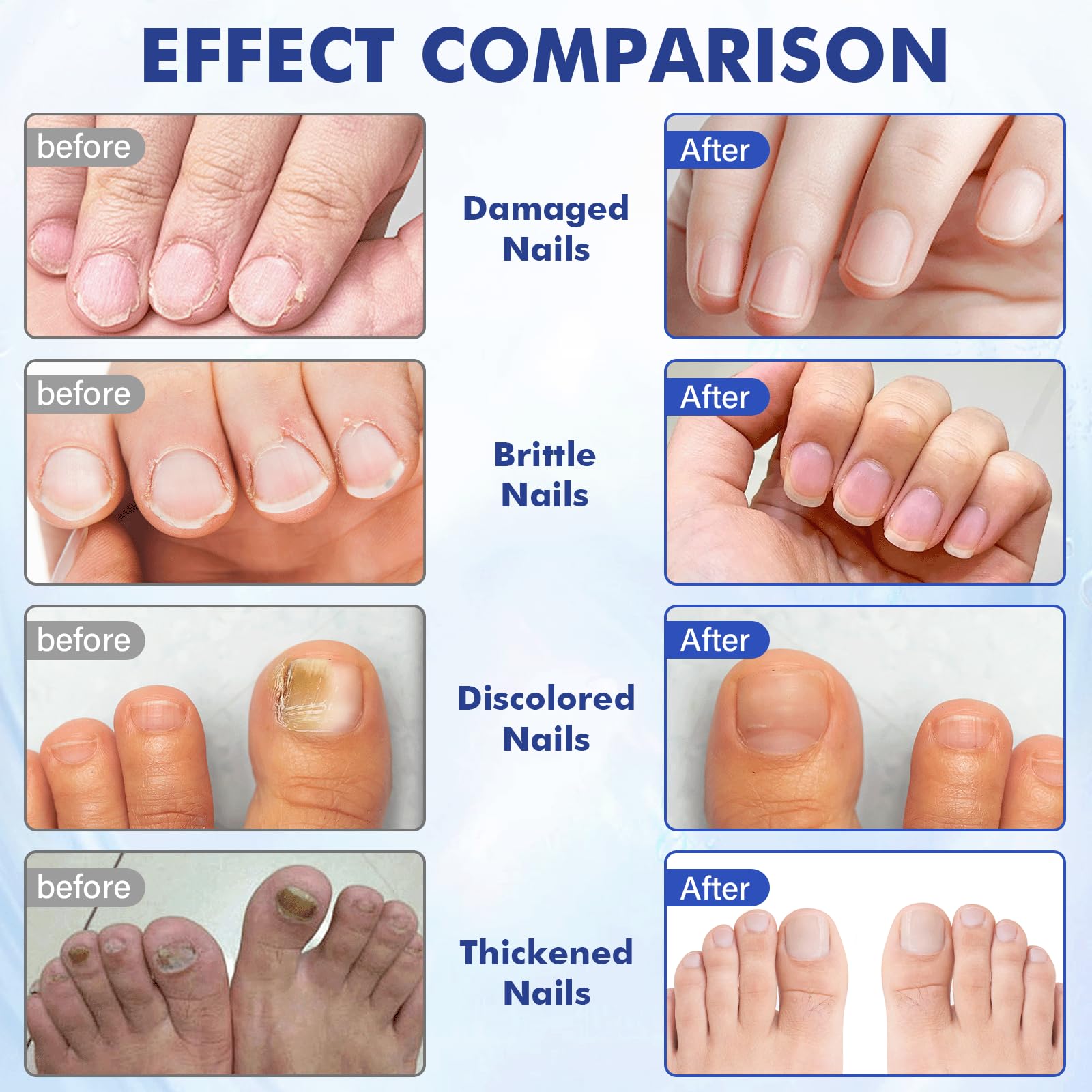 Datunsu Multi-Purpose Nail Repair with Tea Tree Oil | Nail Care Solution for Discolored & Damaged Nails (1 PCS)