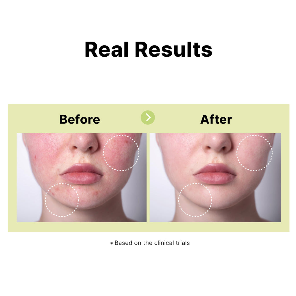 DearMYDEW 10% Azelaic Acid Serum with Niacinamide – Rosacea Relief & Acne Care (1 fl oz)