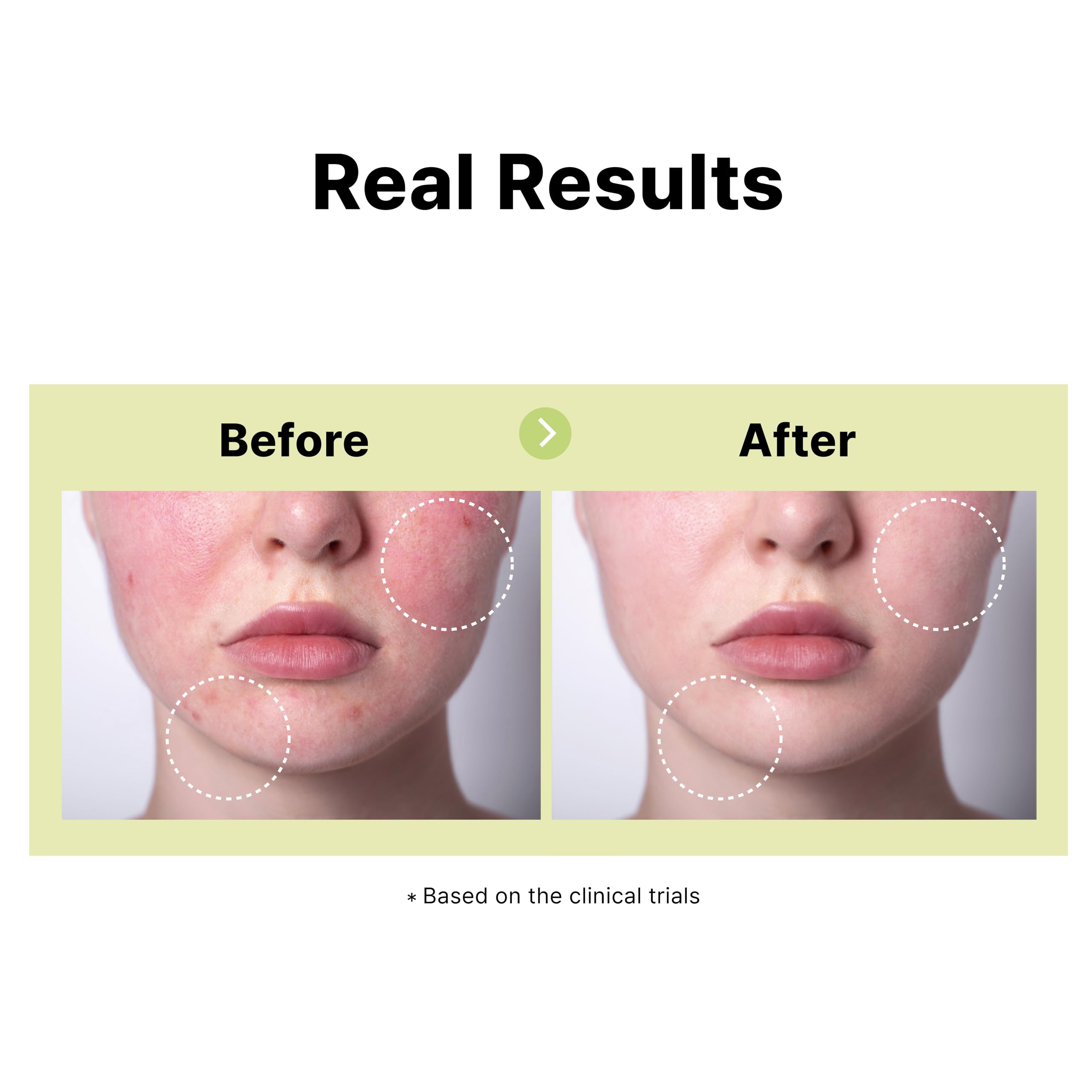 DearMYDEW 10% Azelaic Acid Serum with Niacinamide – Rosacea Relief & Acne Care (1 fl oz)