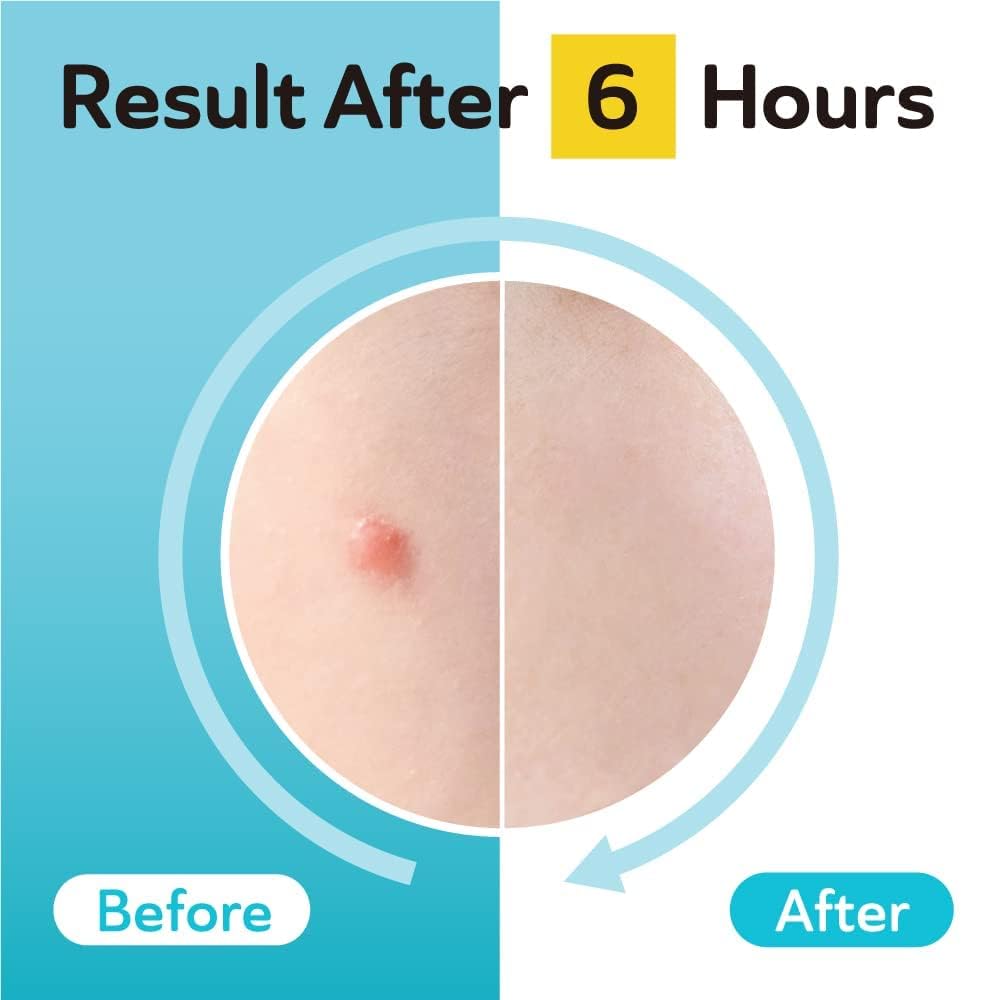 DERMA ANGEL Dark Spot Patches – 96 Count | Hydrocolloid Acne Patches with TXA & CICA for Active Acne & Post-Inflammation