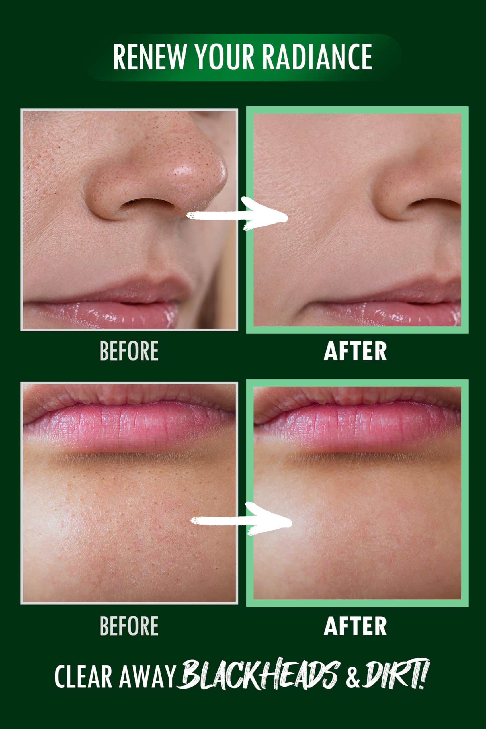 DERMALOGY by NEOGENLAB Pore Zero Peeling Mousse | Foaming Exfoliator for Firming