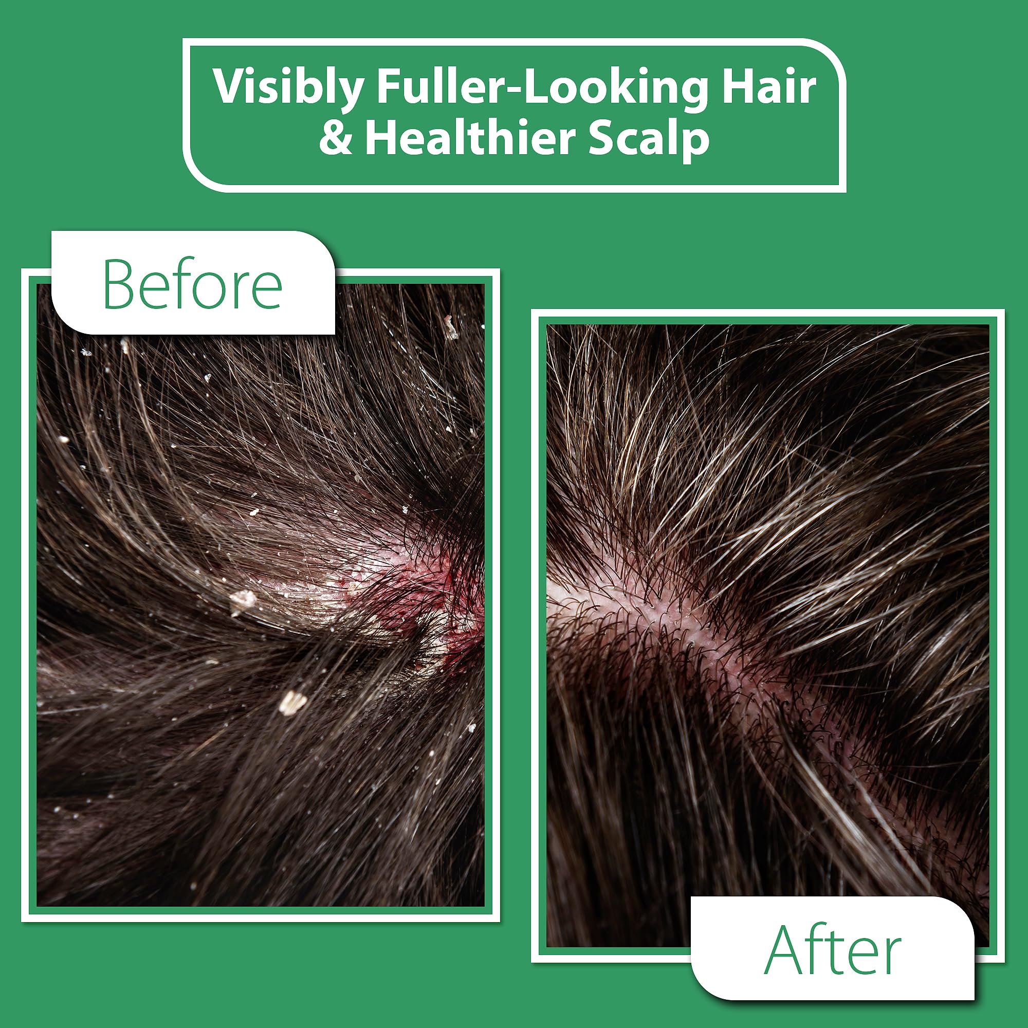 DERMOIA Scalp Serum with Charcoal & Tea Tree – Fragrance-Free Scalp Moisturizer