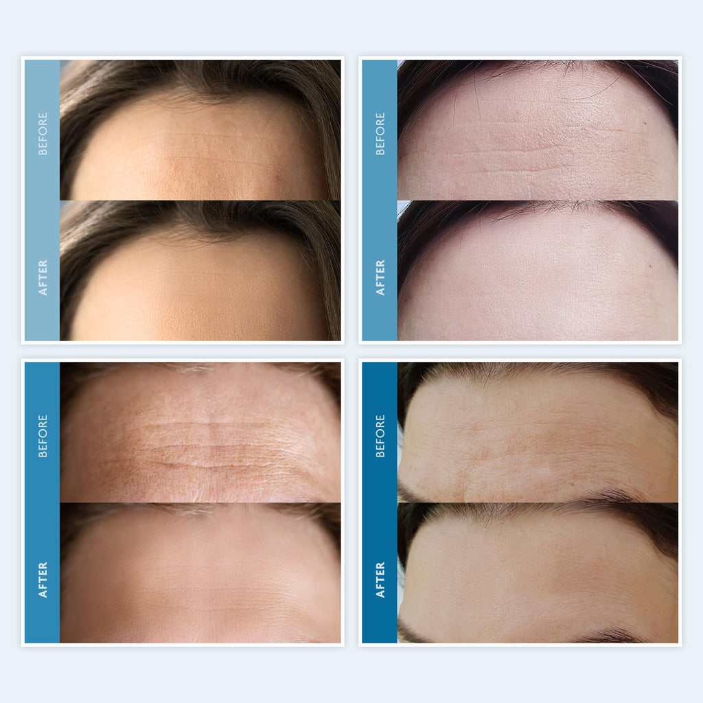 Dersie Silicone Forehead Wrinkle Patches – Overnight Use, Reusable Anti-Wrinkle Pads (3 Pack)