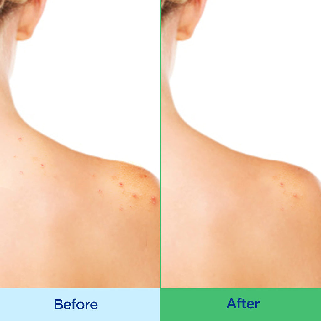 Differin Acne-Clearing Body Wash | 2% Salicylic Acid, Hyaluronic Acid & Blue Tansy | Back, Chest & Shoulders | 10 oz