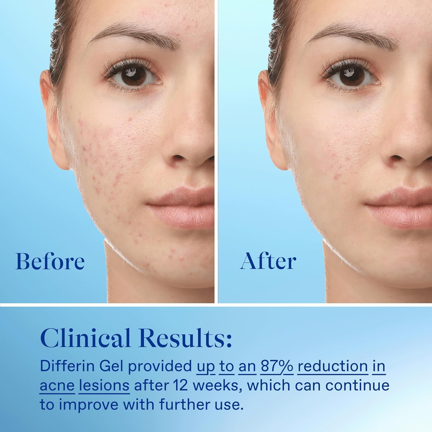 Differin Acne Treatment Gel 0.1% Adapalene – 15g Tube
