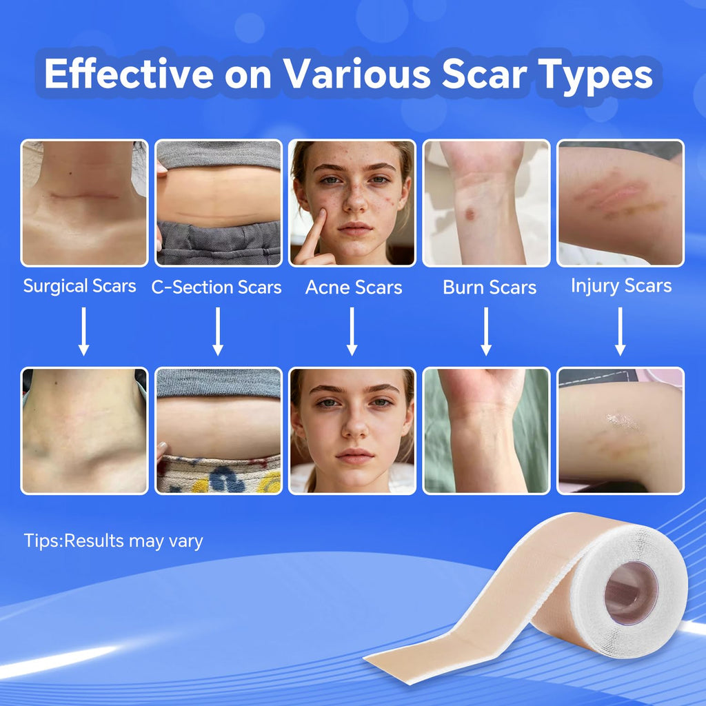Discoliner Silicone Scar Sheets – Reusable Scar Tape (3M) for Surgical, C-Section, Acne & Burn Scars