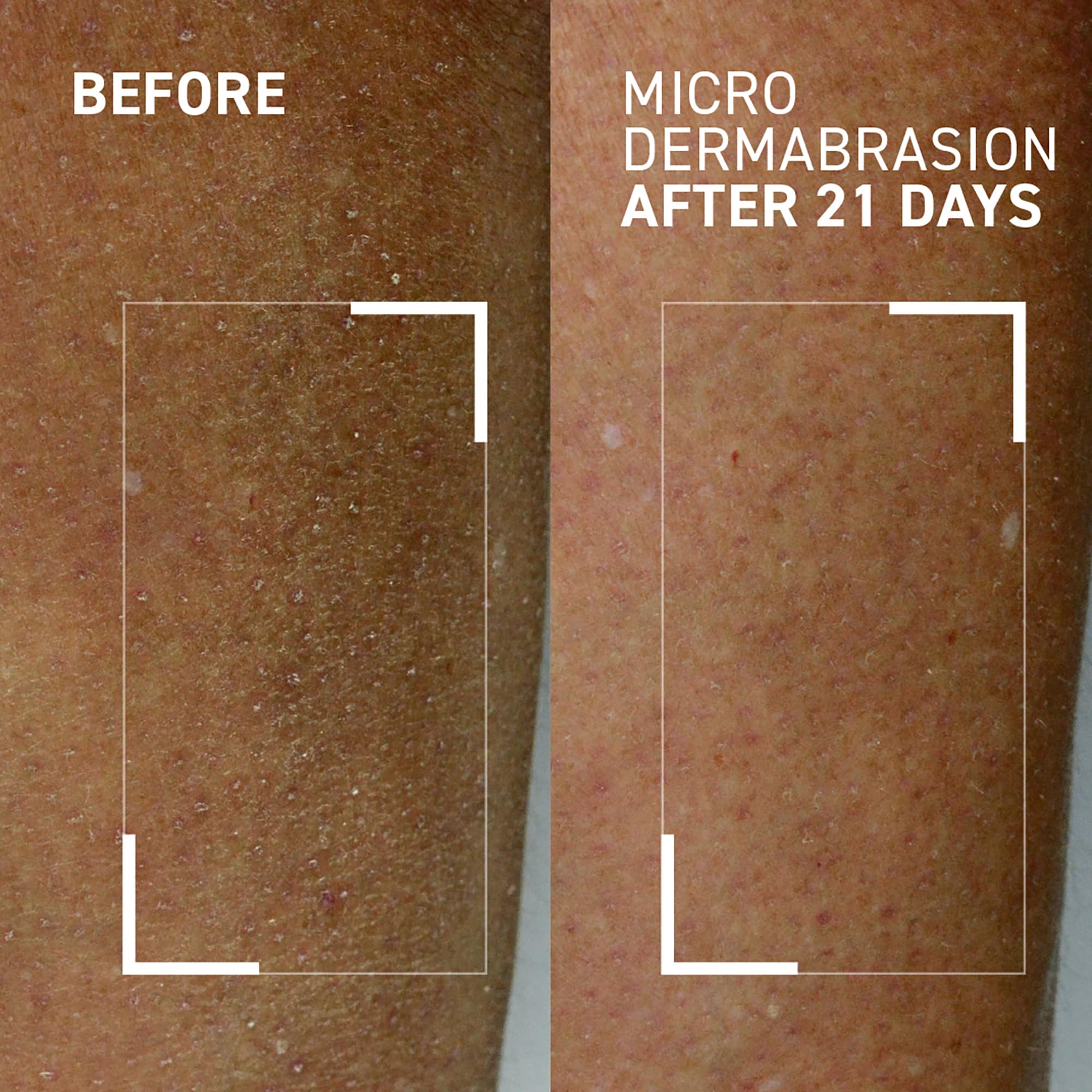Dr. Brandt Microdermabrasion Hydrating Body Exfoliator – Renew Rough, Dry Skin (4.2 oz, Pack of 2)
