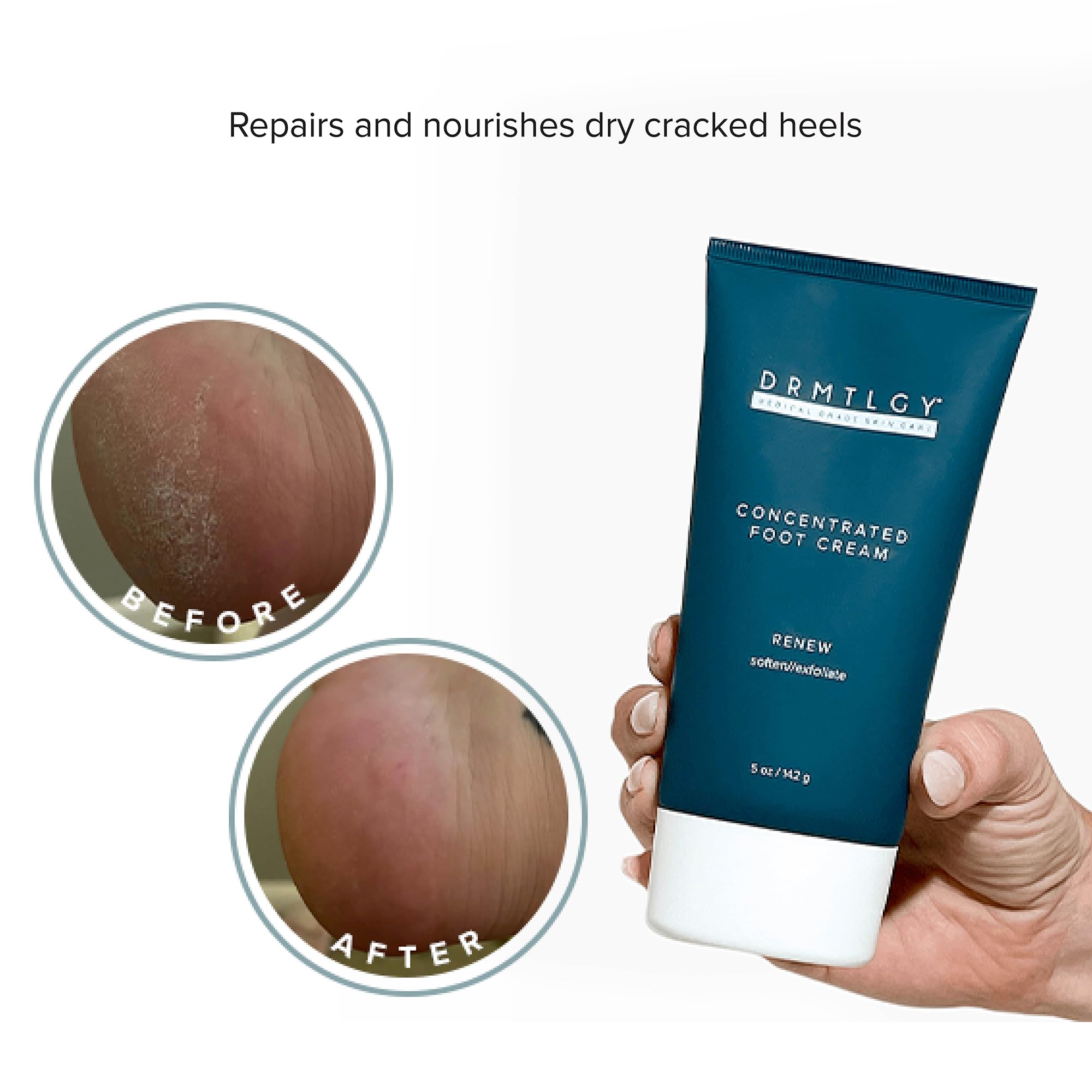 DRMTLGY Concentrated Foot Cream for Dry Cracked Heels | Heel & Foot Lotion