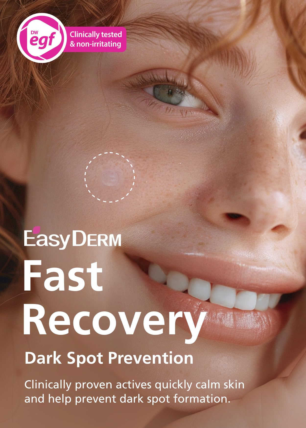 DWEasyDerm Easyderm Real Calming Patch – Pimple Patches with Niacinamide, Hyaluronic Acid & EGF | 24 Patches (4 Packs) | 285µm