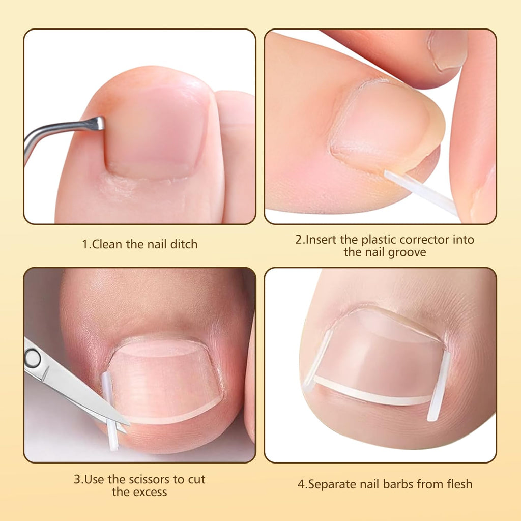 Dynaxor Ingrown Toenail Corrector Kit with Magnifier – Home Nail Care Tools