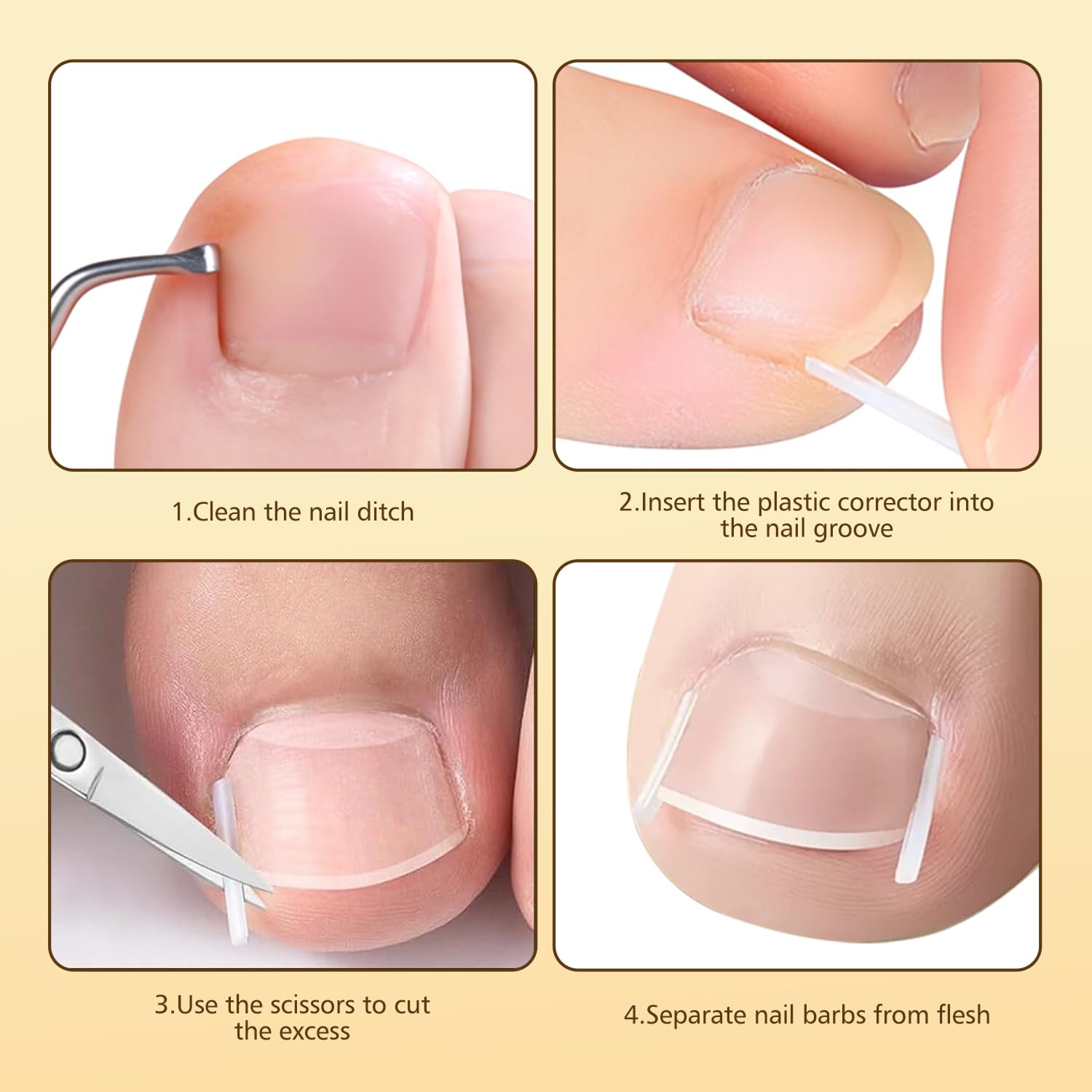 Dynaxor Ingrown Toenail Corrector Kit with Magnifier – Home Nail Care Tools