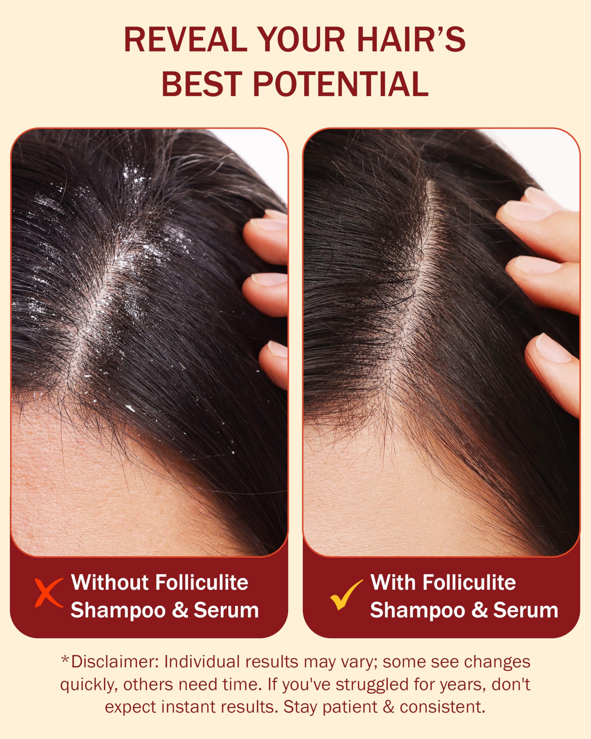 e70 Folliculitis Treatment Shampoo & Serum – 3% BHA, Tea Tree & Chamomile, 8 fl oz
