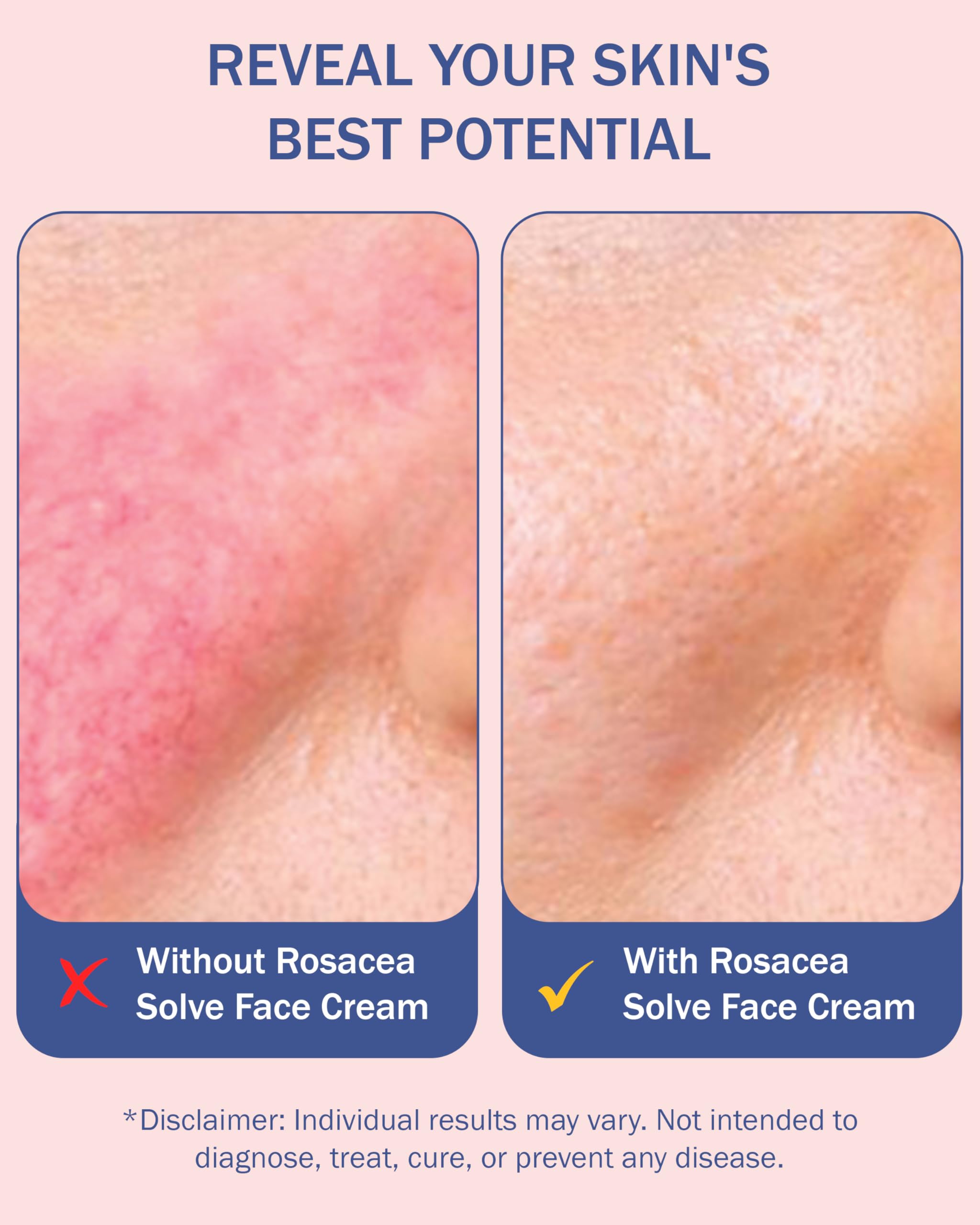 e70 Rosacea Treatment Serum – 10% Azelaic Acid, Niacinamide & HA | Made in USA