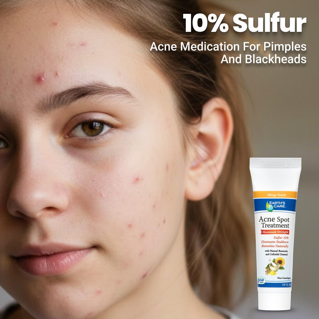 Earth's Care Acne Spot Treatment - 10% Sulfur Cream for Cystic Acne