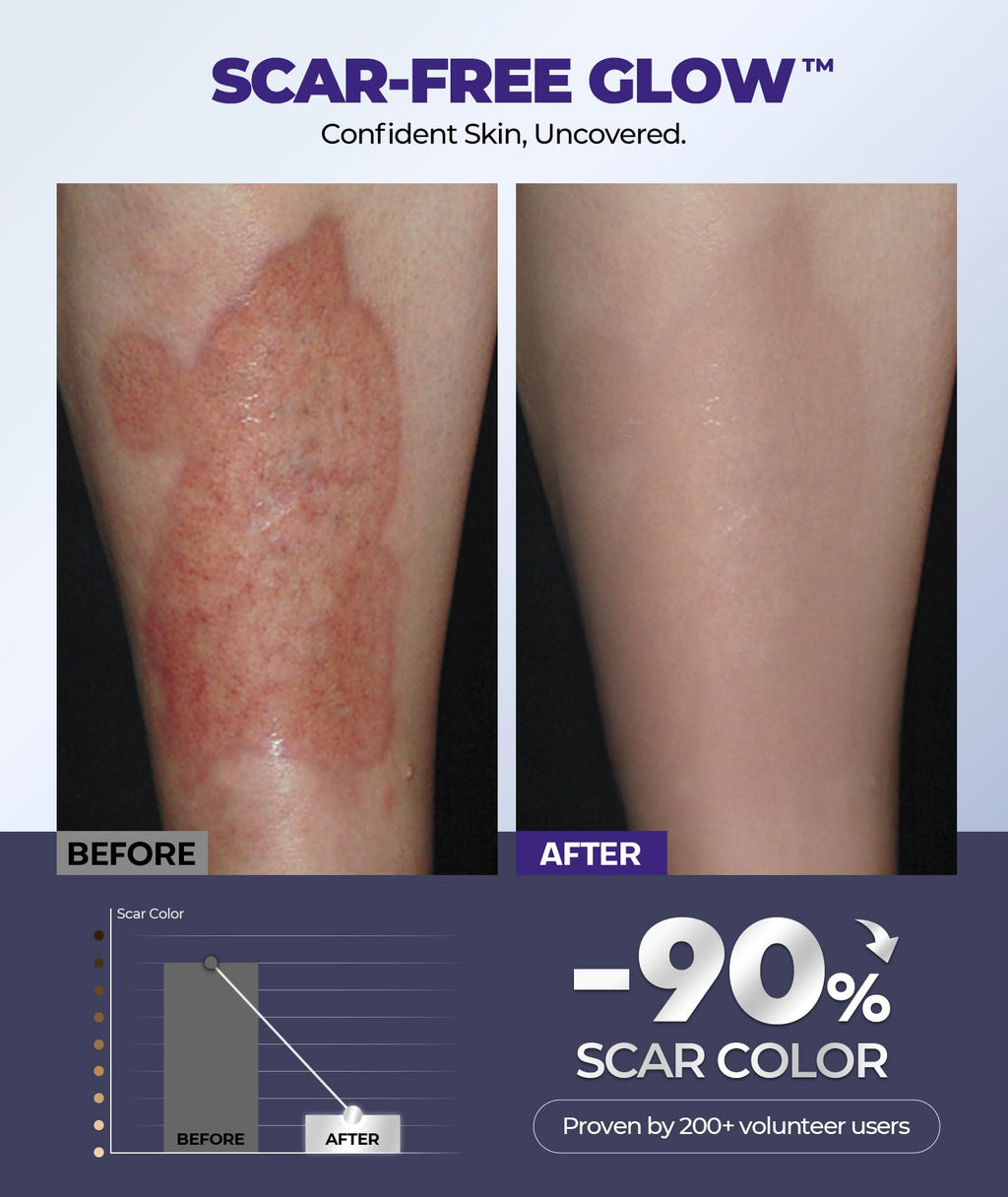 EaseWave Silicone Scar Cream – 6.7% Active, Visible in 2 Weeks, 55ml, For Surgical, C-Section, Acne, Burn Scars and Stretch Marks