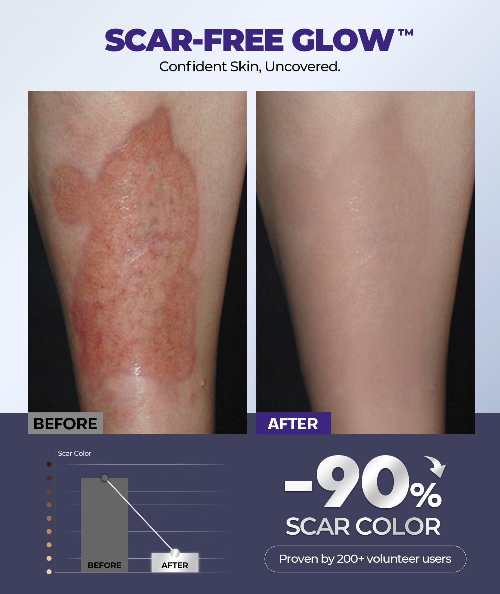 EaseWave Silicone Scar Cream – 6.7% Active, Visible in 2 Weeks, 55ml, For Surgical, C-Section, Acne, Burn Scars and Stretch Marks