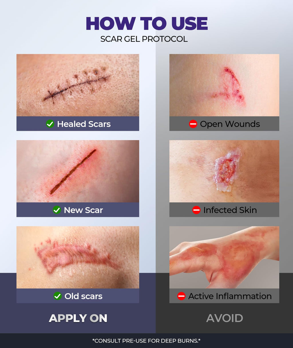 EaseWave Silicone Scar Cream – 6.7% Active, Visible in 2 Weeks, 55ml, For Surgical, C-Section, Acne, Burn Scars and Stretch Marks