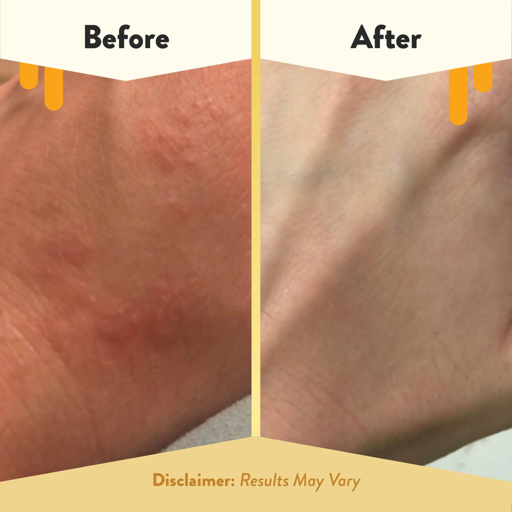 ECZEMA HONEY Oatmeal Body Lotion – Gentle, Natural Dry Skin Care (16 oz)