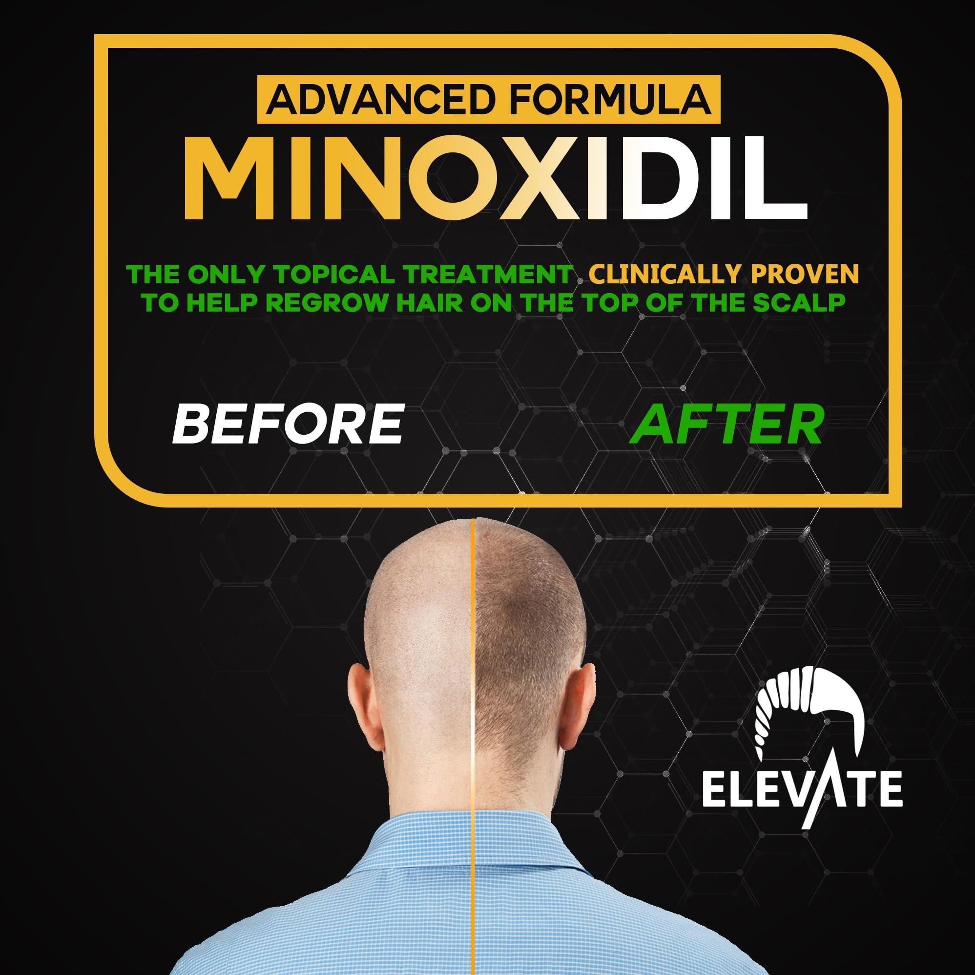 Elevate 5% Minoxidil Hair Regrowth Spray – Extra Strength for Men & Women (1 Month)