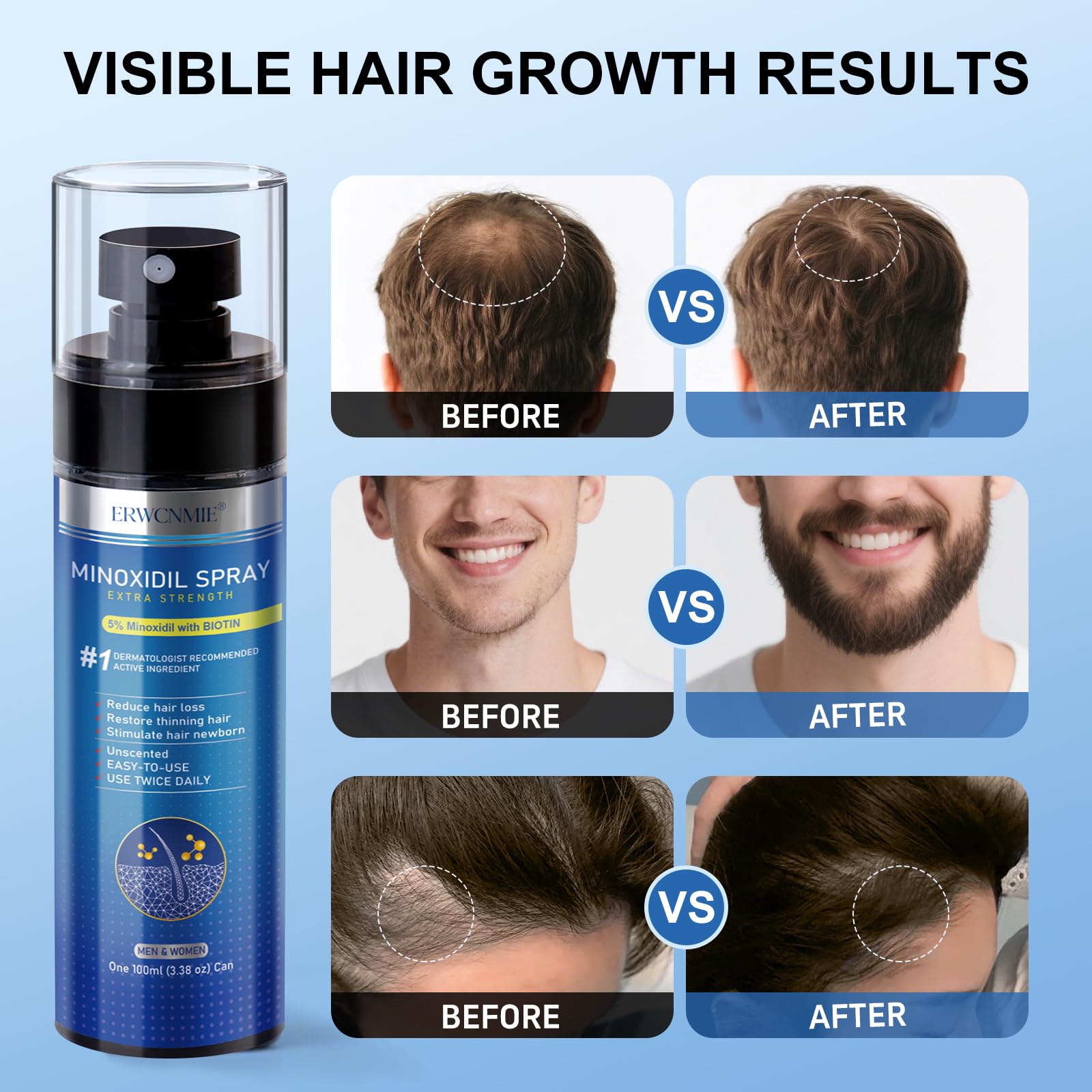 ERWCNMIE 5% Minoxidil Spray for Men & Women – 7 Bottle Pack (11‑Month Supply)