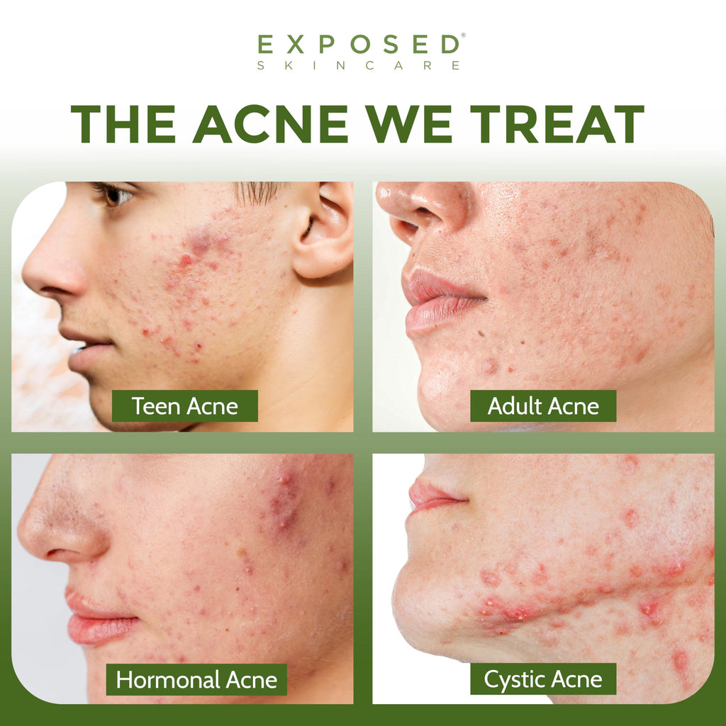 Exposed Skin Care Expanded Acne Treatment Kit – 2.5% Salicylic Acid & 3.5% Benzoyl Peroxide