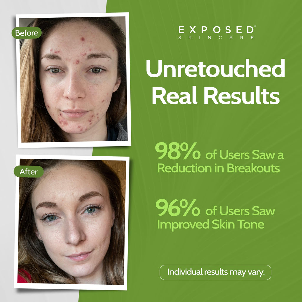 Exposed Skin Care Clear Pore Serum – 1% Salicylic Acid for Sensitive & Oily Skin
