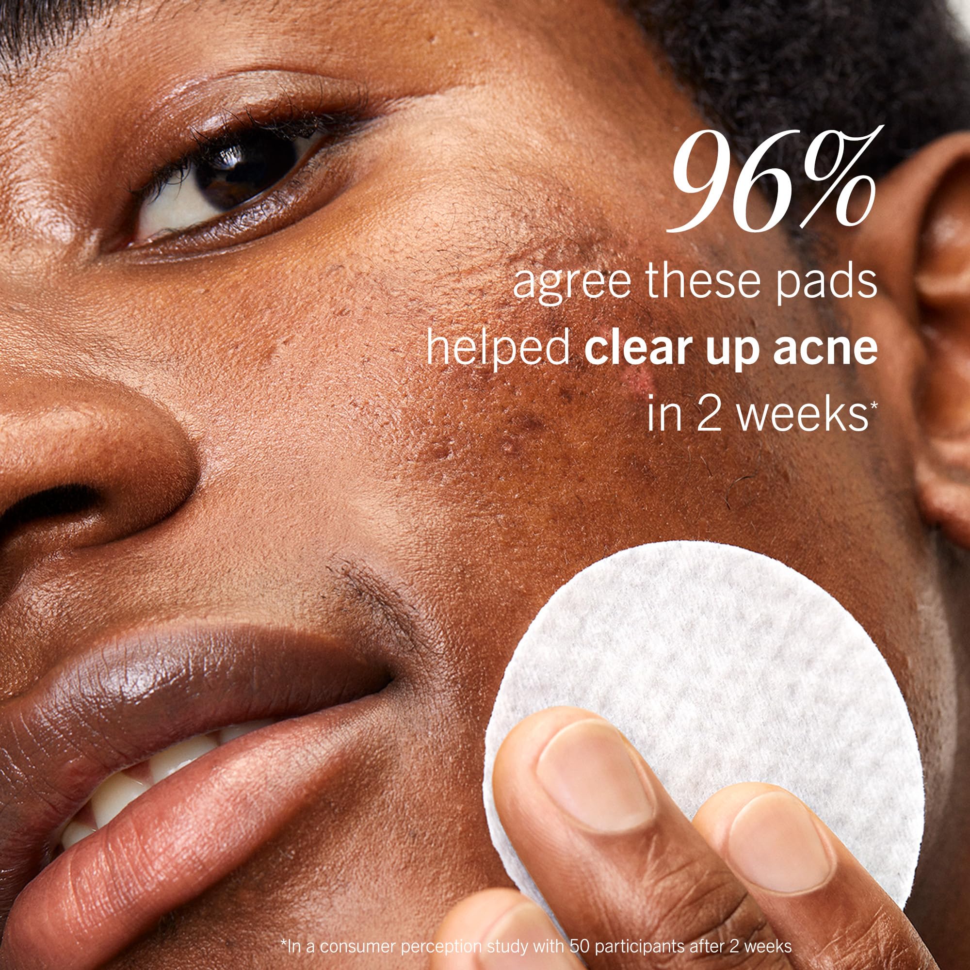 First Aid Beauty Acne Pads – 2% Salicylic Acid, Maximum Strength (60-ct)
